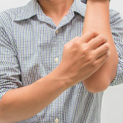 Everything to know about eczema