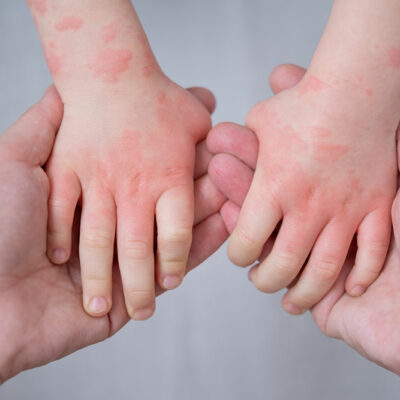 Atopic dermatitis management in children